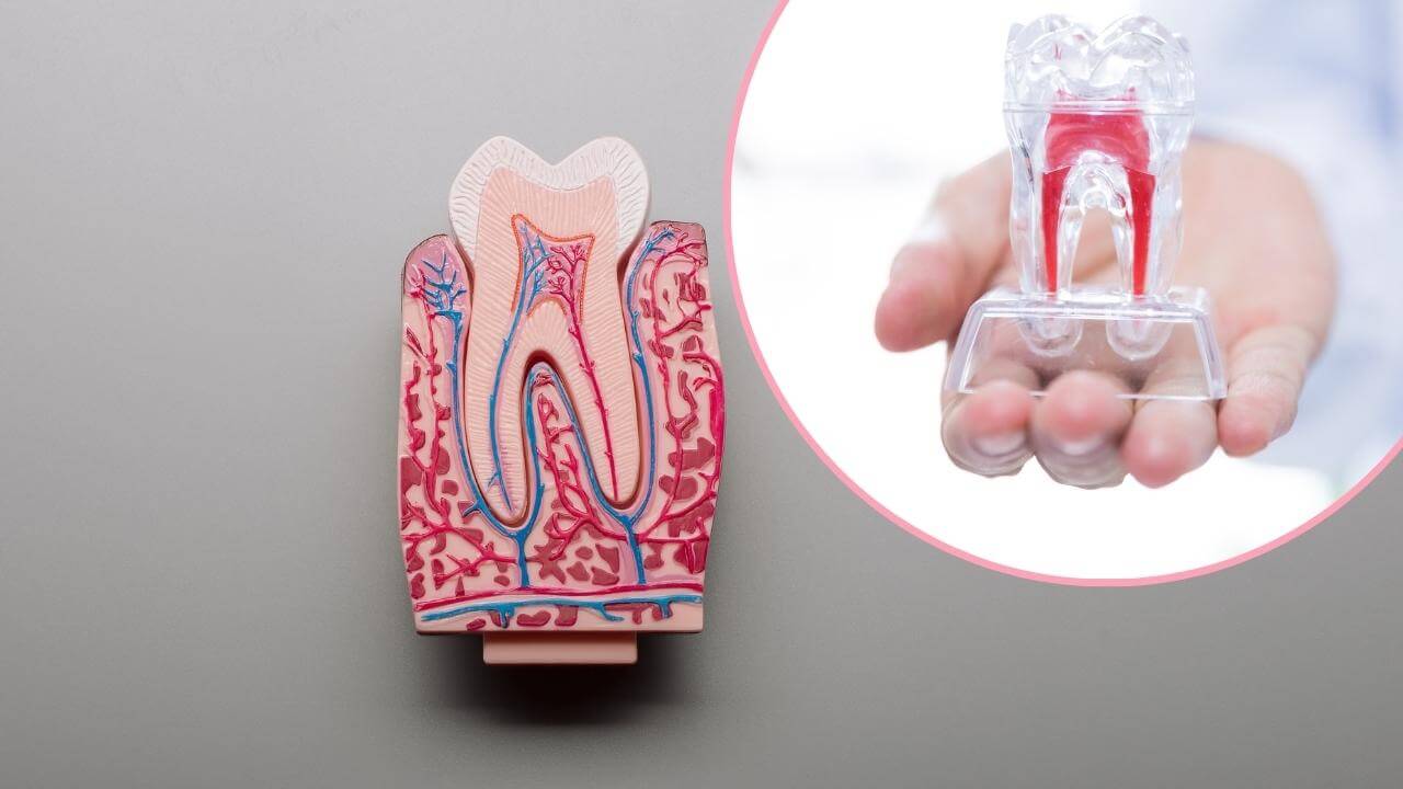 הדגמה להלבנת שן שעברה טיפול שורש