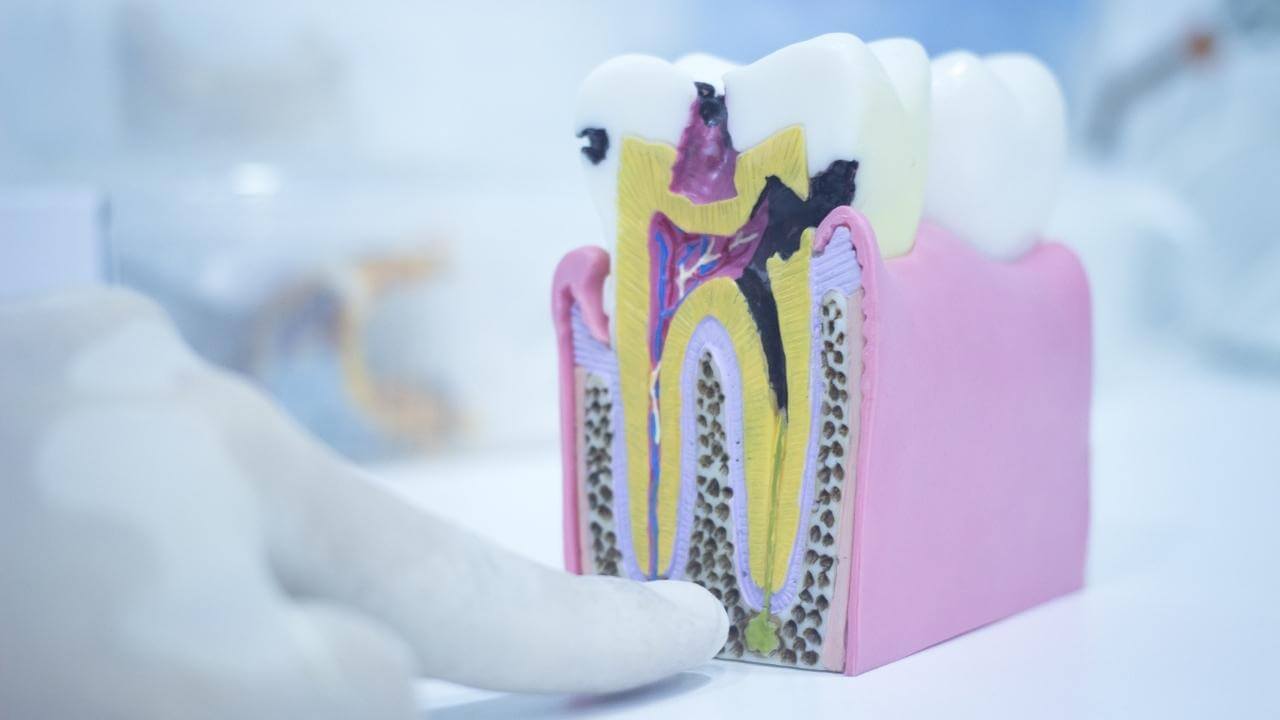 הדמיה של שן נמקית לפני טיפול שורש