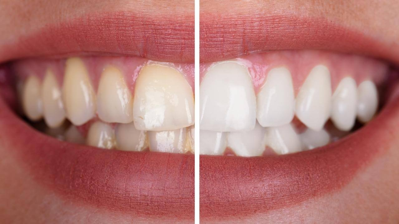 הלבנת שן שעברה טיפול שורש