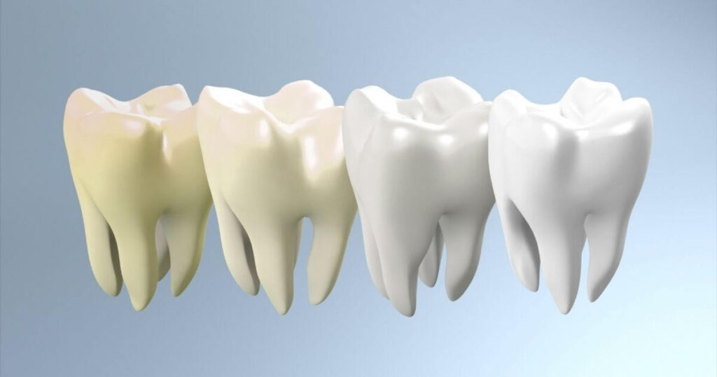 4 שיניים שמראות את התהליך של טיפול שורש