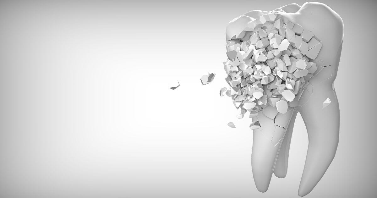Read more about the article סדקים בשיניים וטיפול שורש – מה הקשר בין השניים?