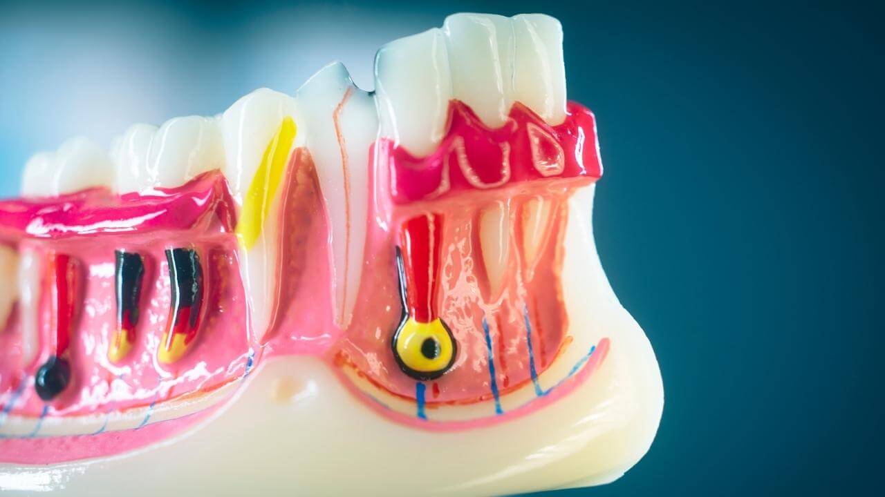 שן נימקית לפני טיפול שורש